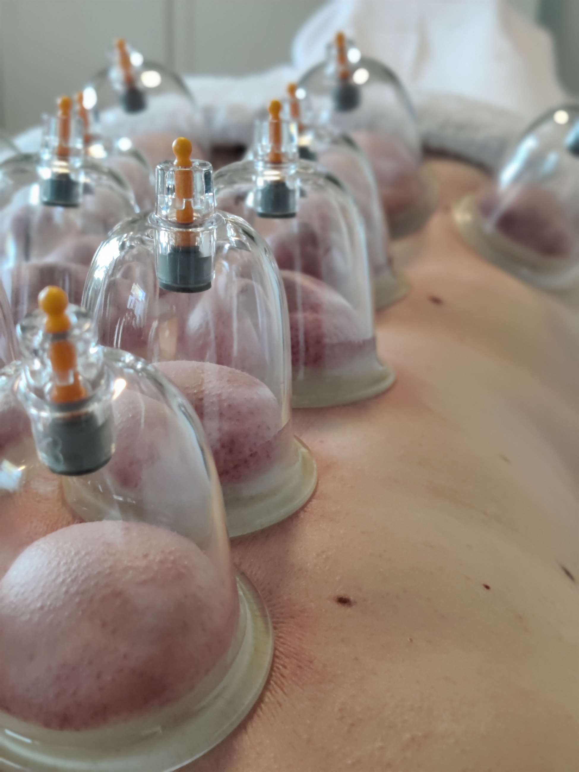 cupping 1