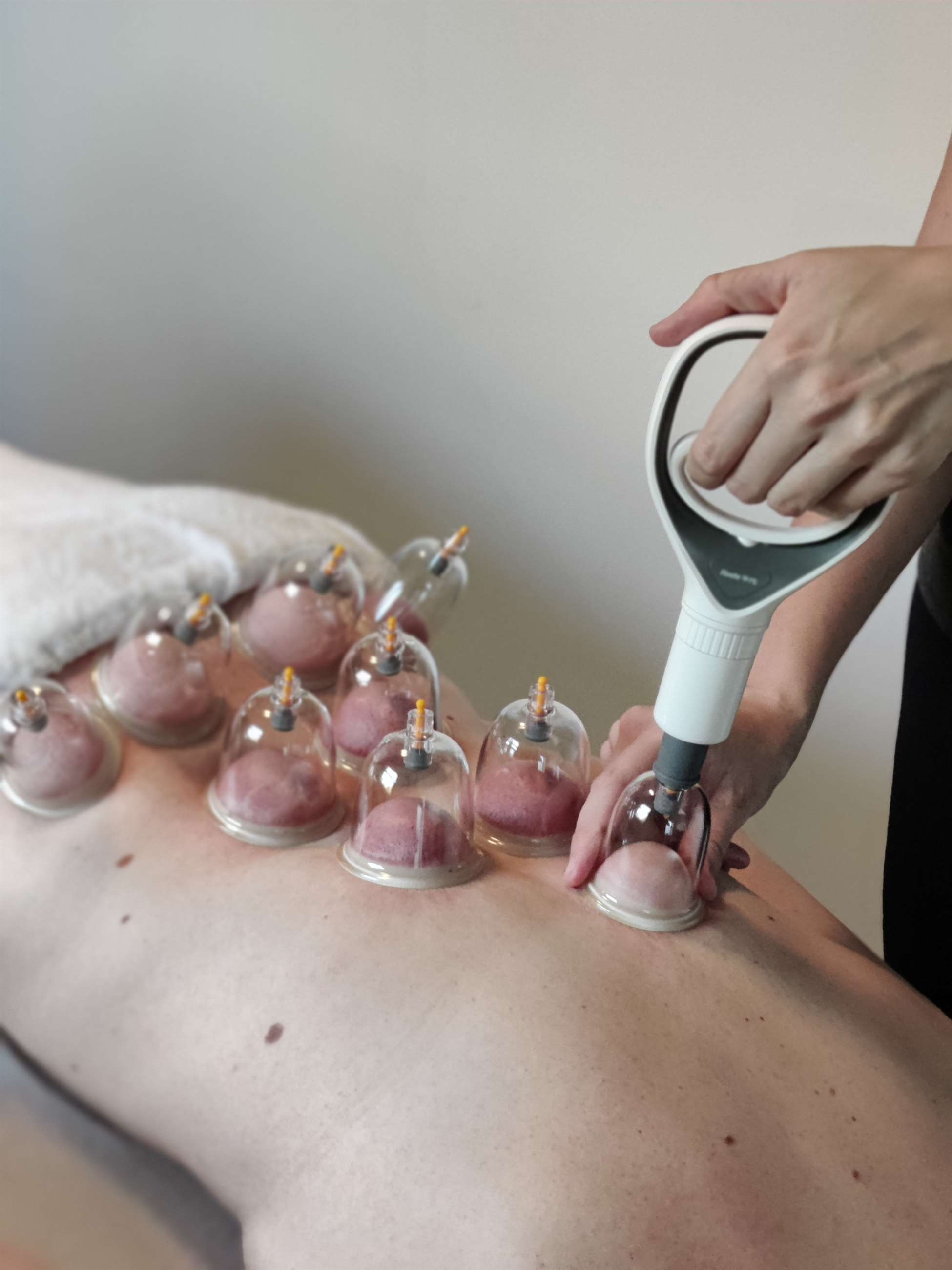 cupping 3